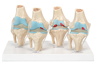 膝關節健康病態比較模型 4階段膝關節病變模型